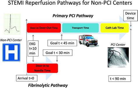 St Segment Elevation Myocardial Infarction Treatment And The Seductive