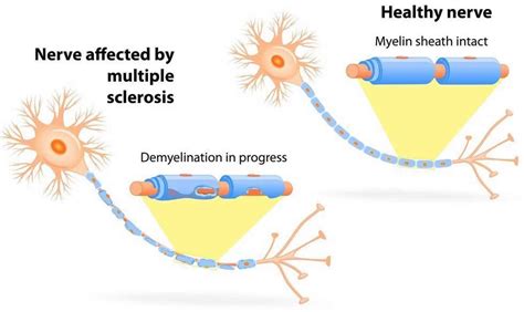 Demyelination Definition Causes Symptoms Diagnosis Treatment