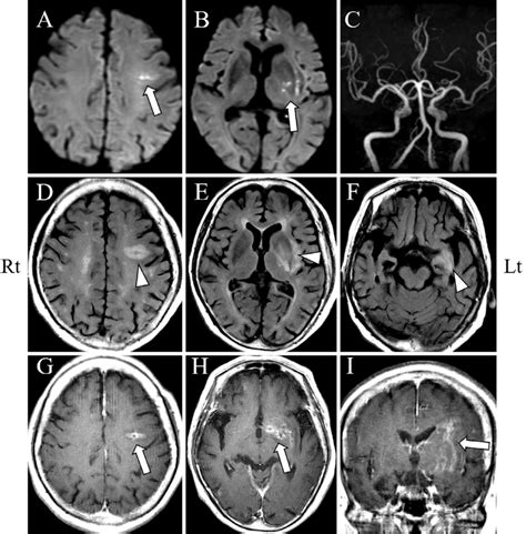 Figure1 Brain Magnetic Resonance Imaging MRI Findings On Admission