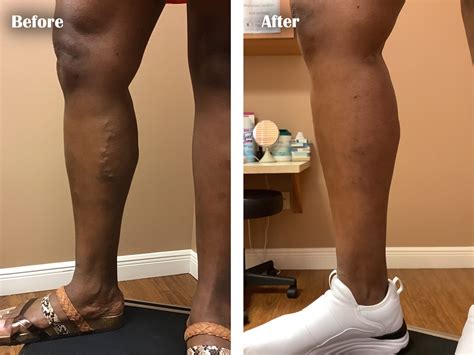 Varicose Vein Surgery Orlando Ambulatory Phlebectomy Orlando