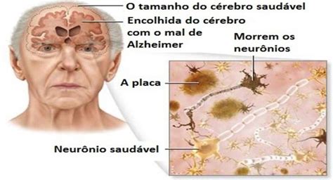 Conselhos Para Prevenir O Mal De Alzheimer Em Alzheimer Mal