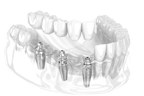 Securing Partial Dentures With Dental Implants | Conroe, TX