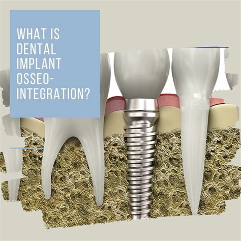 What is dental implant Osseo-integration? | Dental implants, Dental ...