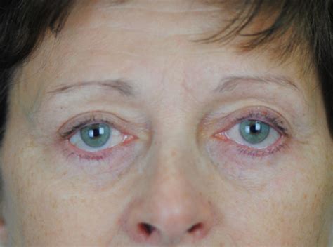 Blepharoplasty Charleston Sc Eyelid Surgery In Mount Pleasant Sc By