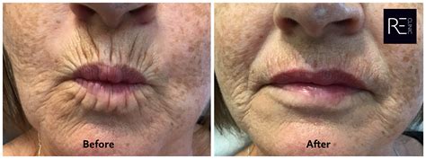 Smokers Lines Botox Treatments REclinic Bicester