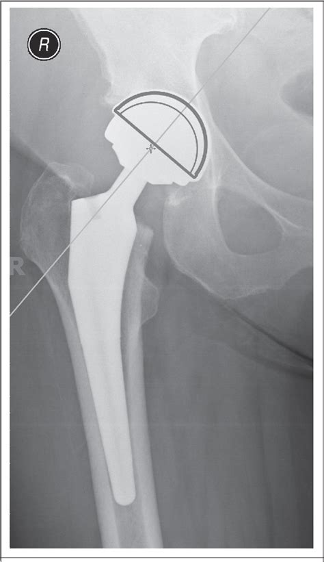 Figure From Assessment Of Magnification Of Digital Pelvic Radiographs