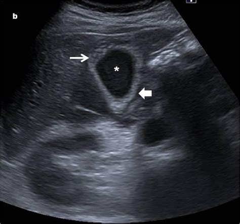 Acute Acalculous Cholecystitis Due To Salmonella Enterocolitis Eurorad