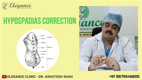 Hypospadias Correction Hypospadias Repair हाइपोस्पेडिया रिपेयर मूत्रमार्ग Surat Gujarat