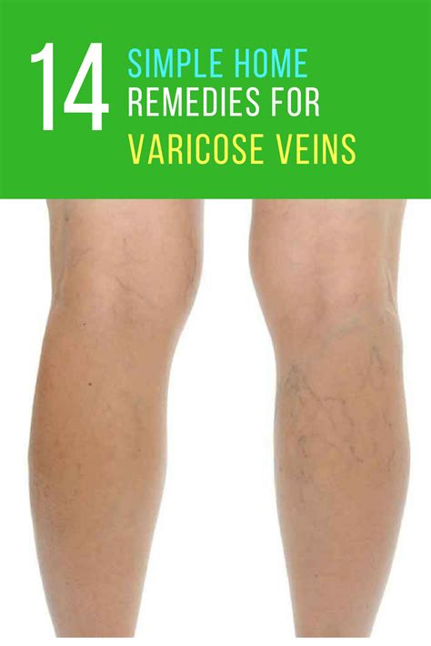 Home Remedies for Varicose Veins - 17 Ways to Get Rid of Them Naturally