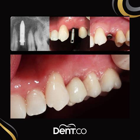 Dental Implants Turkey Dentco