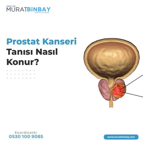 Prostat Kanseri Tan S Nas L Konur Prostat Kanseri Ileti Im