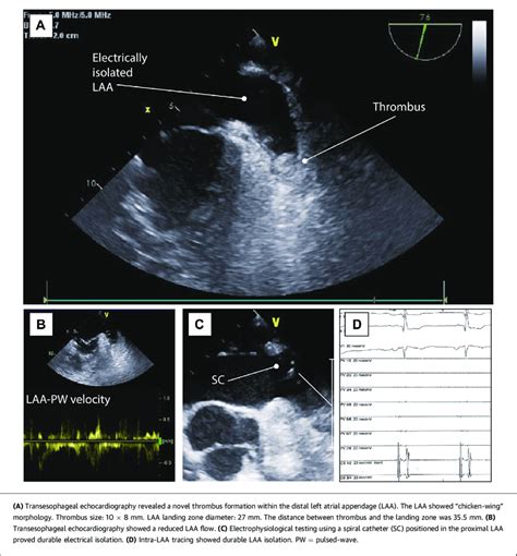 Thrombosis Detected in Electrically Isolated LAA | Download Scientific ...