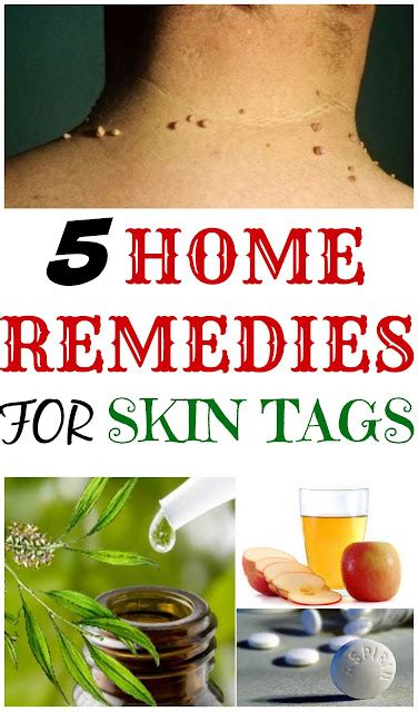 top  home remedies  remove skin tags video natural health care
