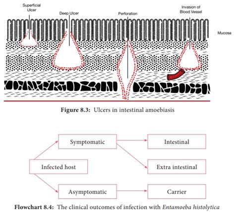 Entamoeba Histolytica Flask Shaped Ulcers