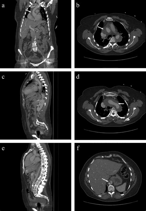 CT aortogram with contrast showing type A aortic dissection. a) Coronal ...