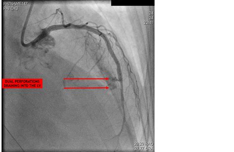 Acquired Coronary Cameral Fistula Due To Post Stent Balloon Dilatation