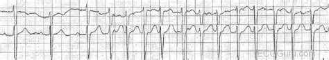 ECG Basics: Onset of Atrial Fibrillation | ECG Guru - Instructor Resources