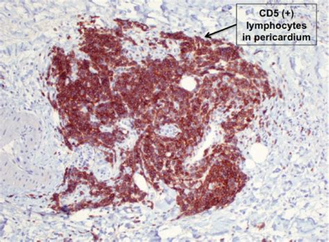 A pericardial biopsy (immunohistochemical stain). CD5 stain of ...