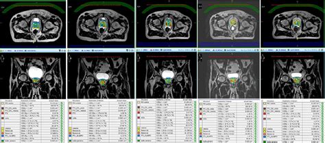 Figure From Mr Guided Hypofractionated Radiotherapy Current Emerging