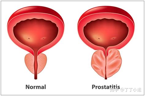 反反复复的慢性非细菌性前列腺炎，如何鉴别和治疗？ 知乎