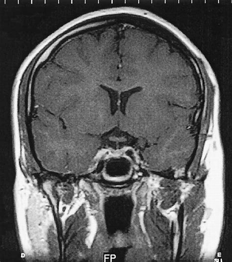 Infundibulum Brain