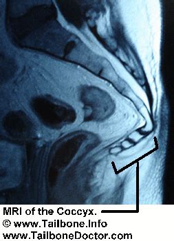 Did MRI show the tailbone | Tailbone Doctor