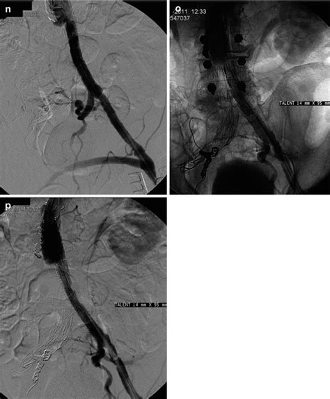 Embolization Of Endoleaks After Endovascular Abdominal Aortic Aneurysm