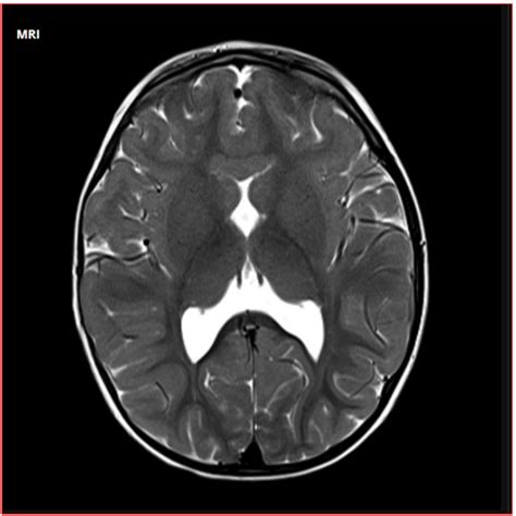 Infant's brain MRI with lobar holoprosencephaly features. | Download ...