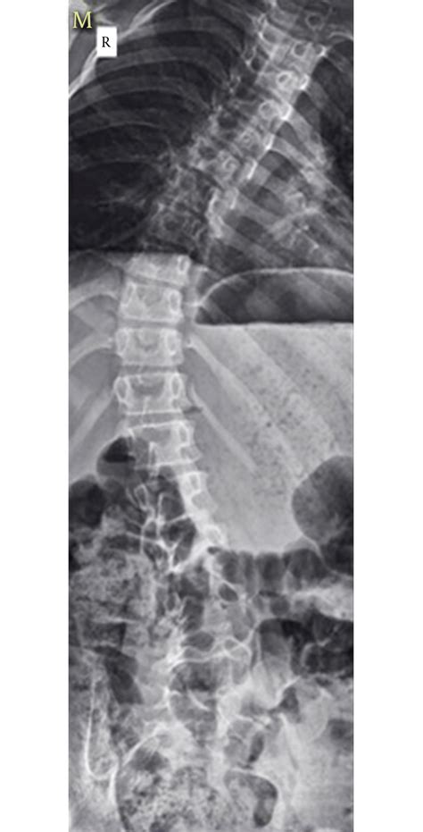 Preoperative Anteroposterior Spine X Ray Download Scientific Diagram