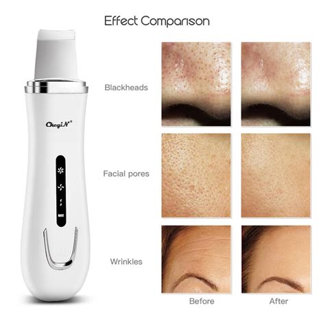 Ultrasonic Skin Scrubber Cleanser Blackhead Remova Grandado