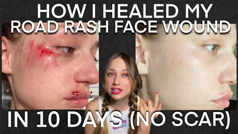 How To Stop Your Wound From Scarring My Facial Road Rash Quick Healing