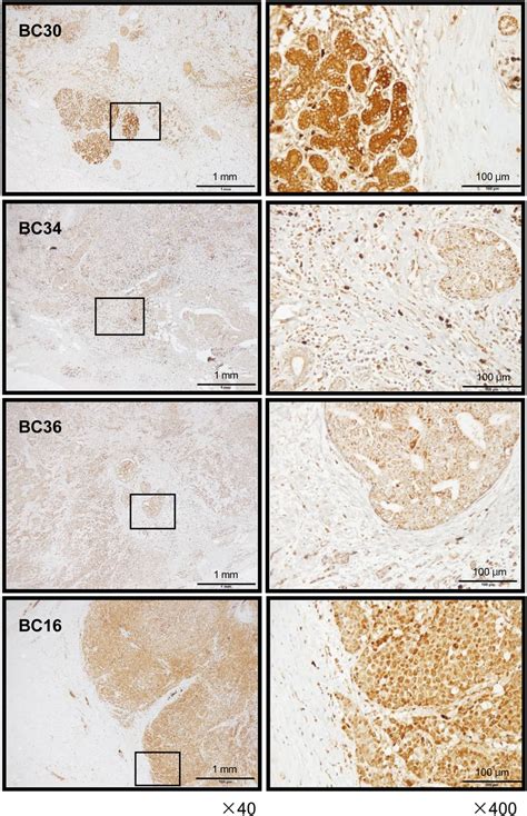 Expression Of GINS1 In Clinical BrCa Tissues Immunohistochemistry