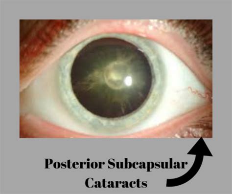 Cataract Symptoms How Do You Know If You Have Cataract