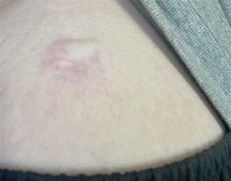 Painful Red Lump On Abdomen R Askdocs