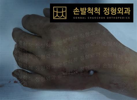 손발척척 정형외과 수술센터 수술센터 수술센터 중수골 골절로 인한 수술과 재활 손뼈 수술과정과 재활