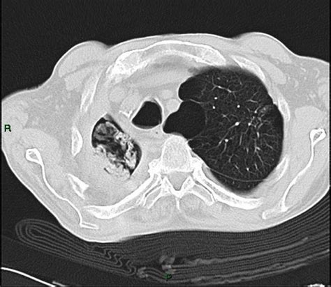 Journal Of Brown Hospital Medicine On Twitter A 47 Year Old Man P W 2