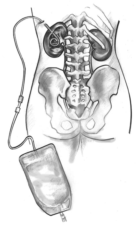 How To Take A Shower With A Nephrostomy Tube at Edward Gratwick blog