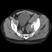 Chondrosarcoma Radiology Reference Article Radiopaedia Org