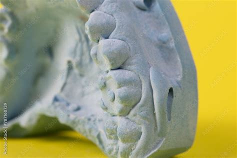 Blue plaster impression of a patient's dental jaw with crooked teeth ...