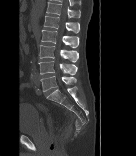 Coccygeal Fracture. - NeuroRad911 Coccygeal fracture