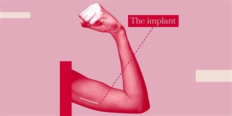 Everything you need to know about the contraceptive implant - Flipboard