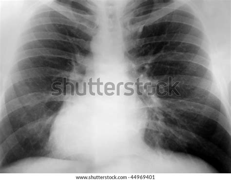 Xray Chest Positive Exposure Showing Dextrocardia Stock Photo Edit Now