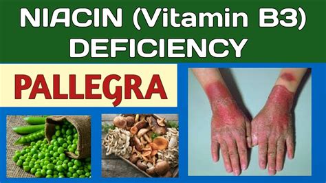 Pallegra Niacin Vitamin B3 Deficiency Sources Causes Symptoms