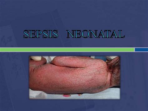 Tetanos Y Sepsis Neonatal