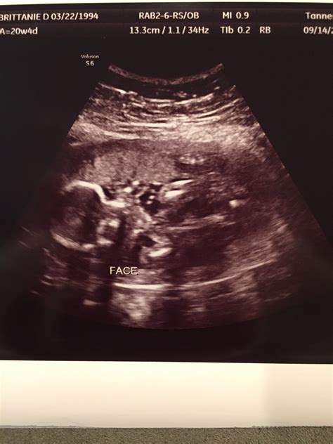 Normal 20 Week Ultrasound