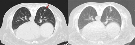 Ct Guided Transthoracic Biopsy Of The 9 Mm Cavitary Lung Nodule