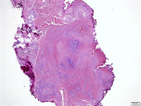 Pathology Outlines - Rheumatoid / rheumatic nodules