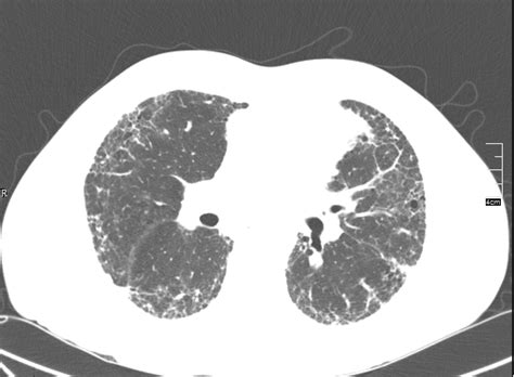 Hrct Scans Used To Evaluate Idiopathic Pulmonary Fibrosis