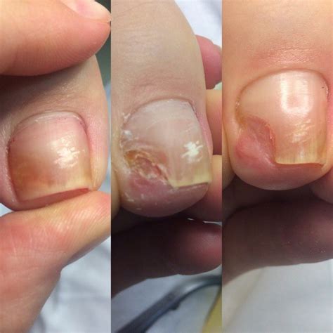 The Appearance Of Onycholysis After Gel Polish 10 Photos Treatment