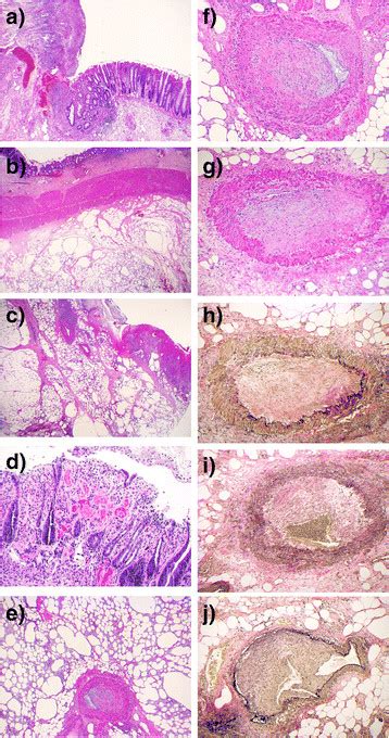 Histology of the resected recto-sigmoid colon: a) Scanning power view... | Download Scientific ...